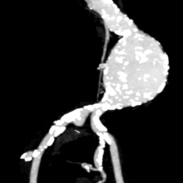 Aneurisma de aorta abdominal