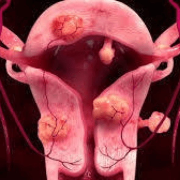 Embolização de miomas uterinos