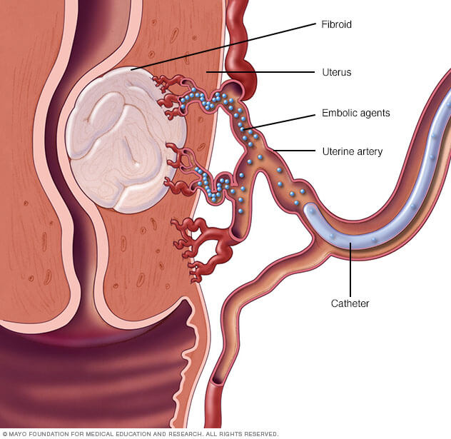 Embolização de miomas uterinos