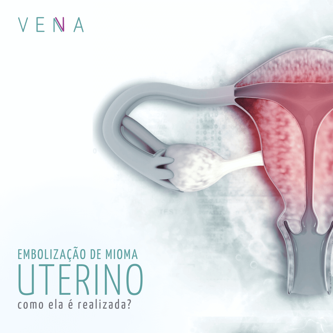 embolização-de-mioma-uterino