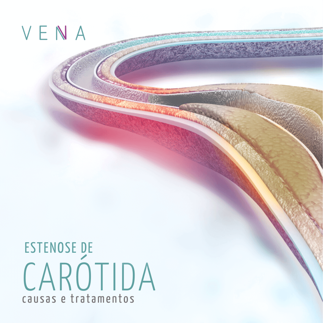 estenose-de-carótida