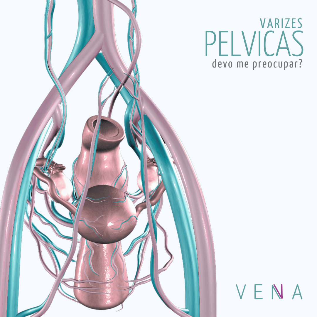 varizes-pélvicas