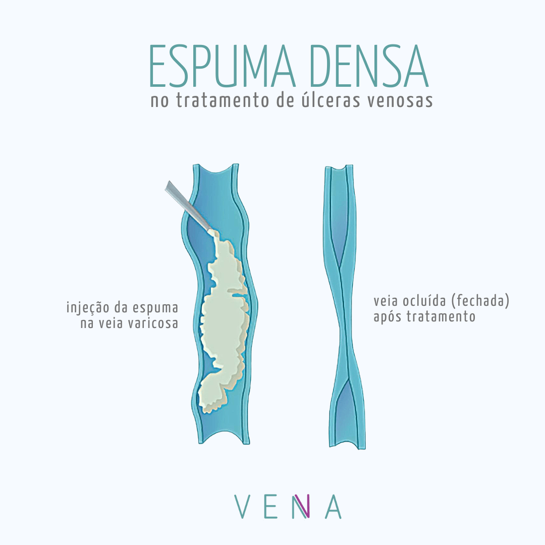 espuma-densa