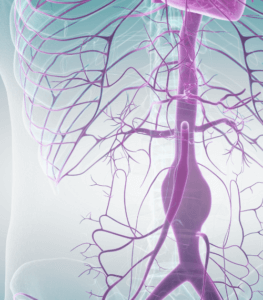 Correção de aneurismas de aorta