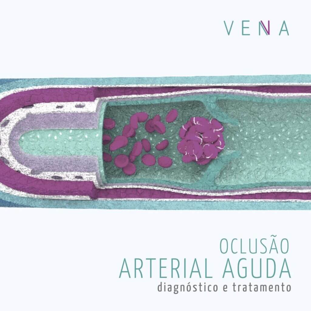 oclusão-arterial-aguda