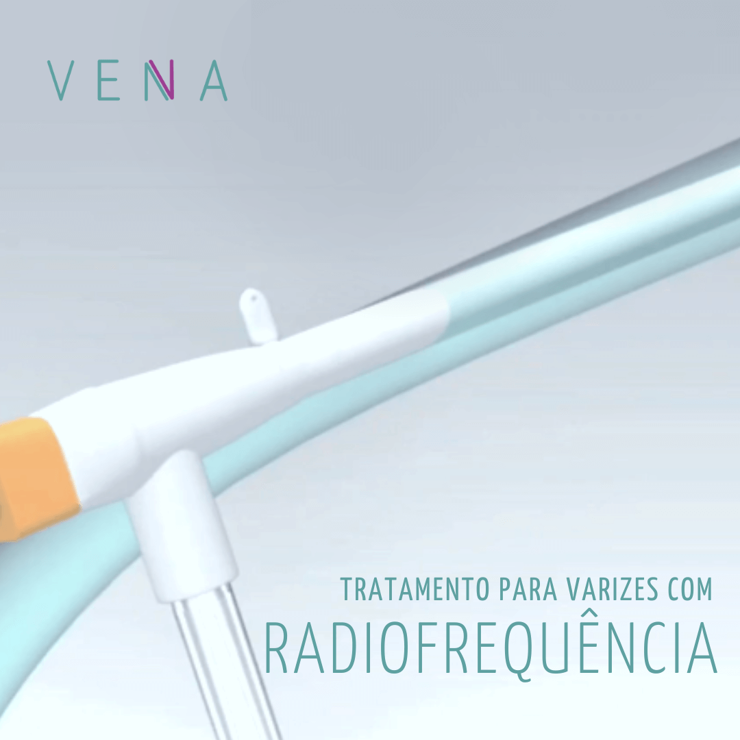 Tratamento para varizes com radiofrequência