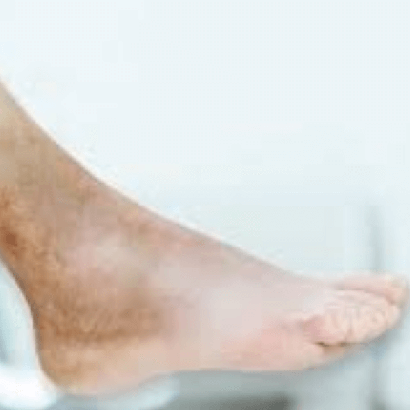 Pé com dermatite