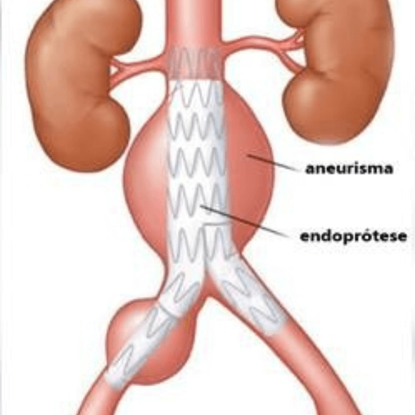 Aneurisma de aorta