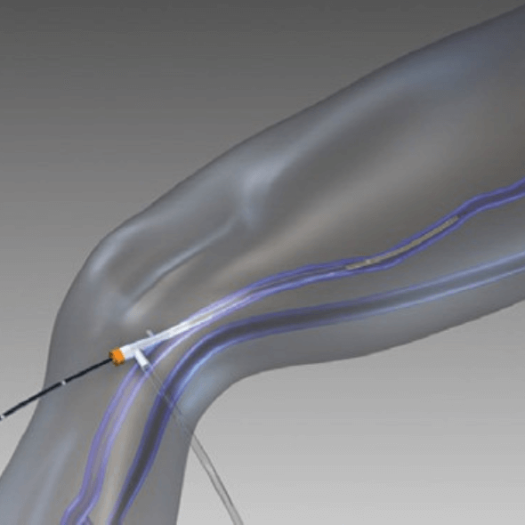 Tratamento de varizes com radiofrequência e escleroterapia intraoperatória.