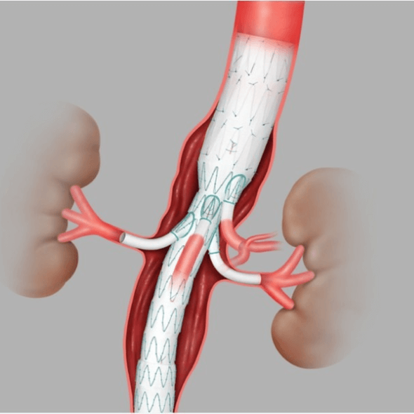 Tratamento envascular de aneurismas complexos