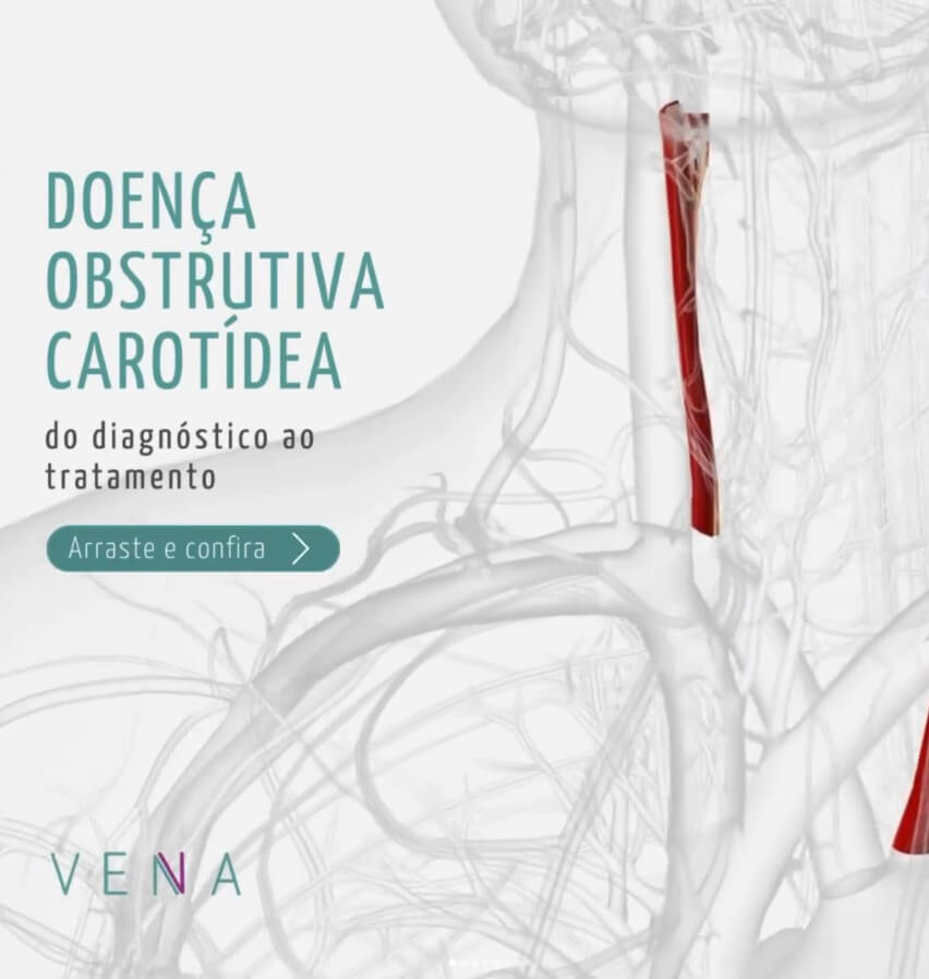doenca-obstrutiva-carotidea