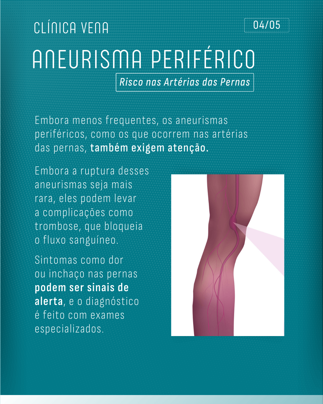 aneurismas-alem-do-cerebro