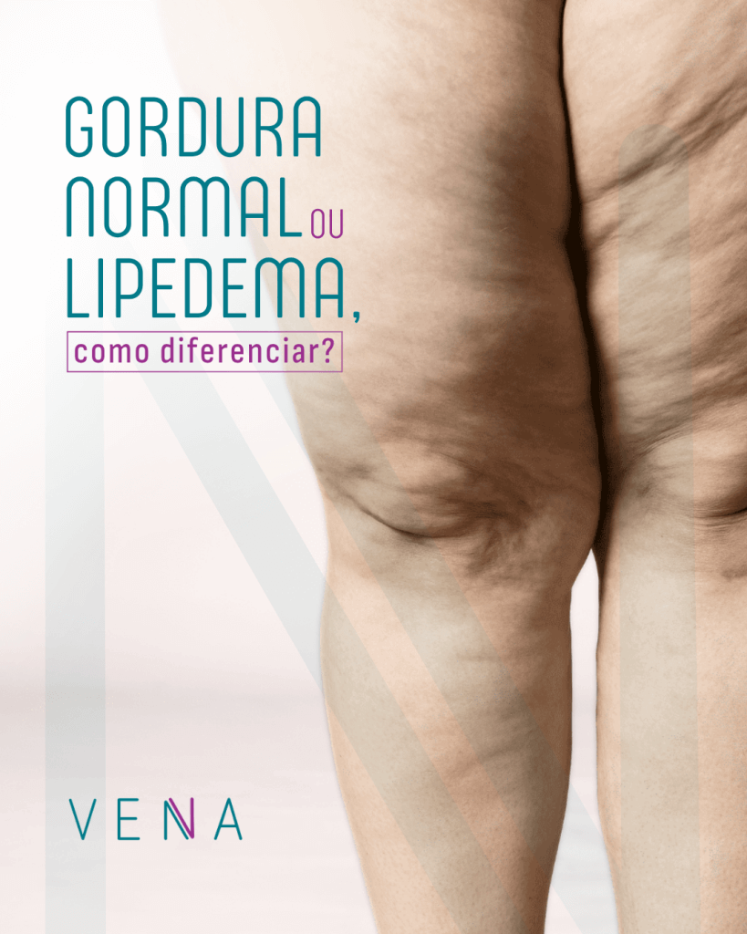 gordura-normal-e-lipedema