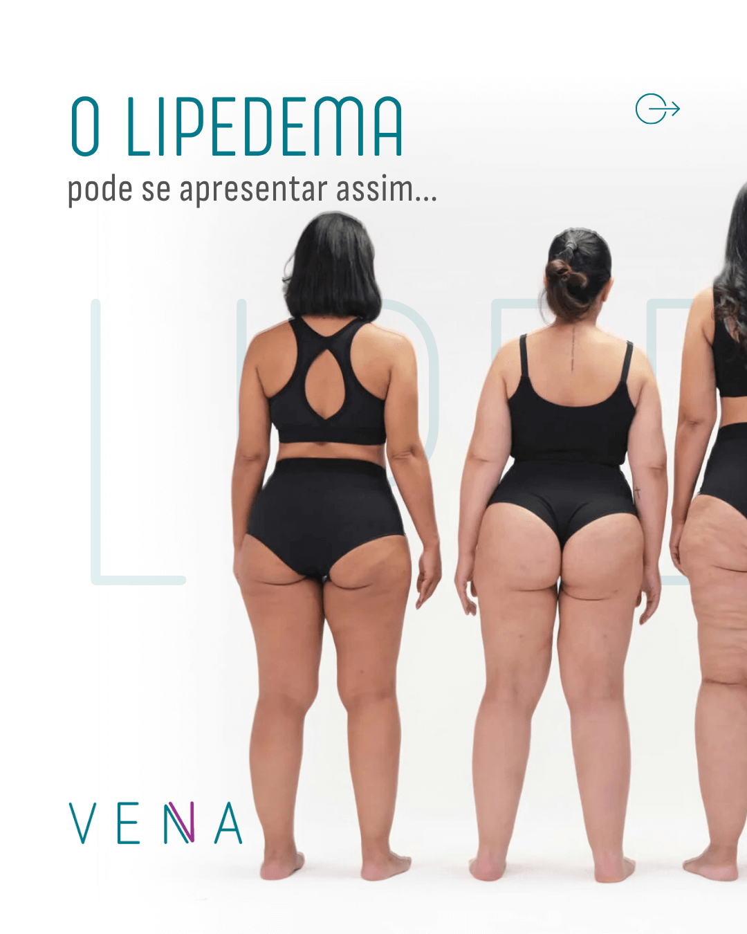 o-lipedema-nao-tem-uma-forma-unica